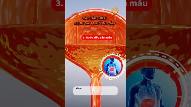 Dấu hiệu nhận biết bệnh gan смотреть онлайн