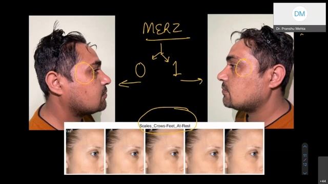 Facial Plastics | Upper facial Botox & Lower facial Botox | Dr Pranshu Mehta смотреть онлайн