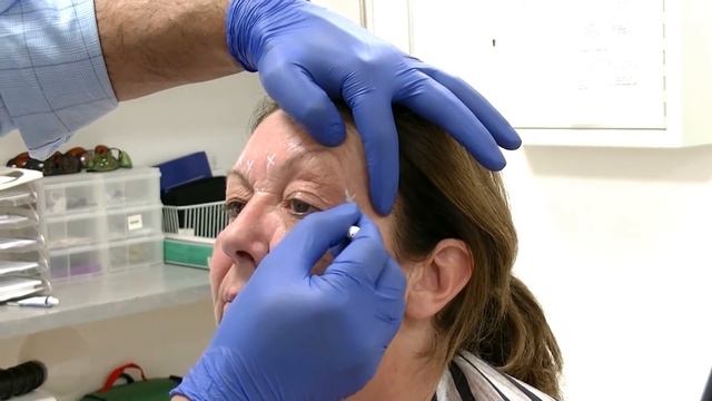 Injecting Botox Into The Glabella Region - Training Video For Medical Professionals Only