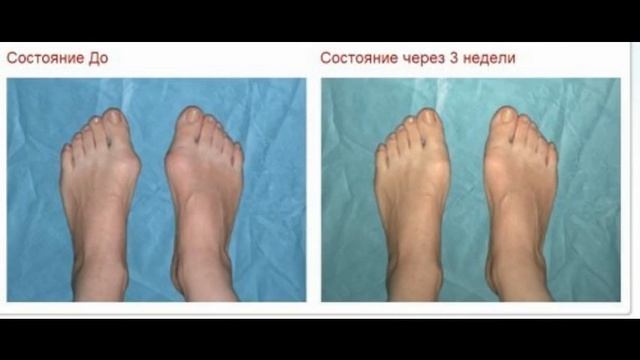 косточка на ноге врач смотреть онлайн