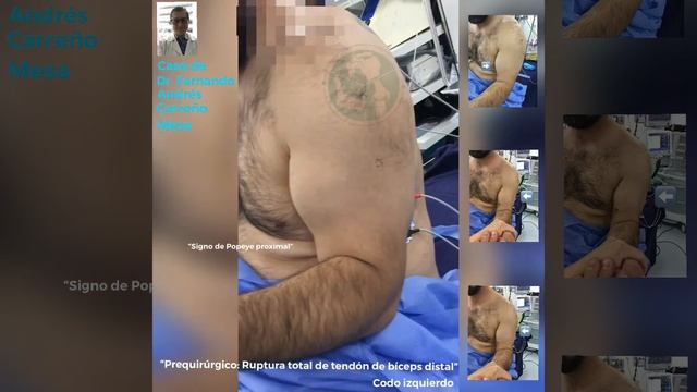 VIDEO CASO 2: EXAMÉN FÍSICO PRE-QUIRÚRGICO DE RUPTURA BÍCEPS DISTAL смотреть онлайн