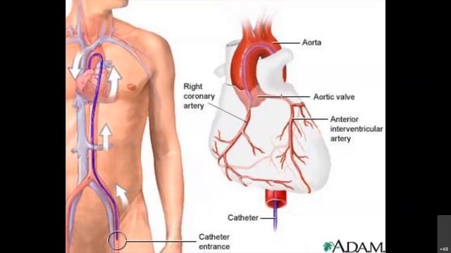 lecture 9 | STEMI - Cardiology Secret Codes