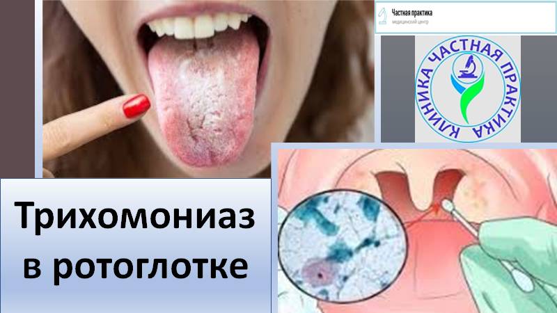 Трихомониаз в ротоглотке смотреть онлайн
