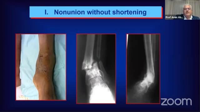Infected Nonunion ( Prof. Amin Abdel-Razek ) смотреть онлайн