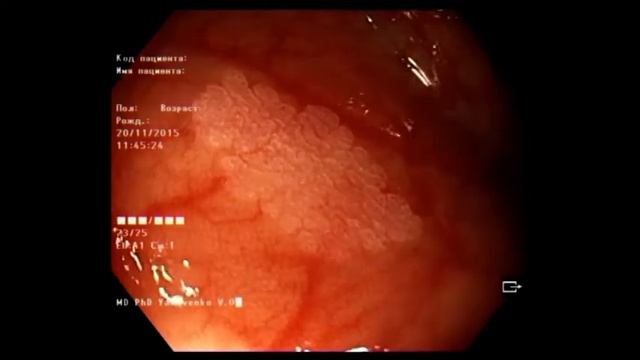 Acetic acid vs NBI with dual focus for diagnosis of flat colon lesion смотреть онлайн