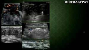 Лекция "Ультразвуковая диагностика молочной железы"