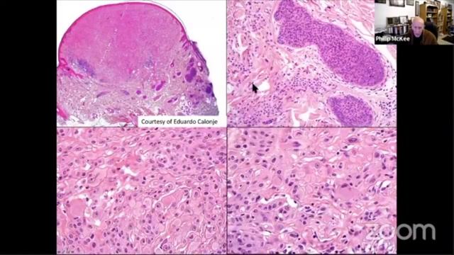 Edited BAPoma and kinase fusion Spitzoid tumors Phillip McKee смотреть онлайн