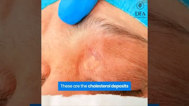 Removal of Xanthelasma by Dr. Fazeela Abbasi смотреть онлайн