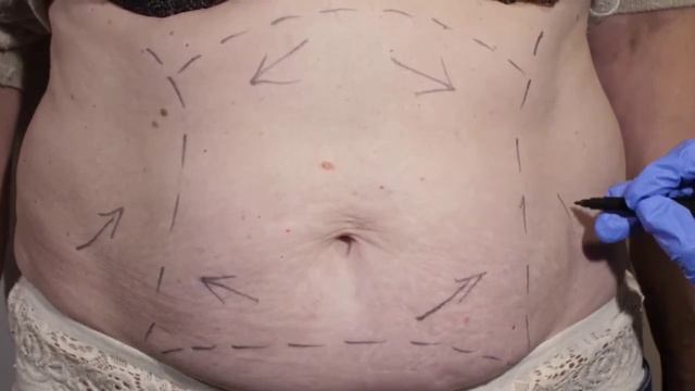 Liposuction in Turkey and body sculpting, the best plastic surgery clinic and prices смотреть онлайн