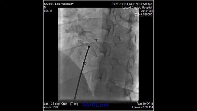 Sabbir 37 yrs 84 Kg Large ASD II Device closure done by 24 mm Cera Device смотреть онлайн