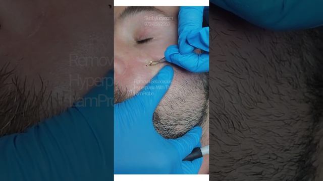 Removal Sebaceous hyperplasia from face using LamProbe смотреть онлайн