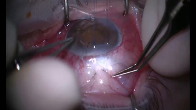 Bleb Revision for Hypotony with Trans Conjunctival Flap Sutures смотреть онлайн