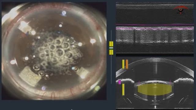 Flacs In Small Pupils ANAND EYE HOSPITAL смотреть онлайн