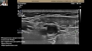 УЗИ сонных артерий. Выявлен стеноз бифуркации ОСА ( 4 года назад не было)