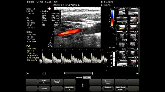 2020061114444763 ТКДС