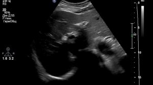 УЗИ надпочечников. Аденома? Пациентка нашего эндокринолога: Чехрановой Евгении Сергеевны.