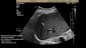 УЗИ органов брюшной полости