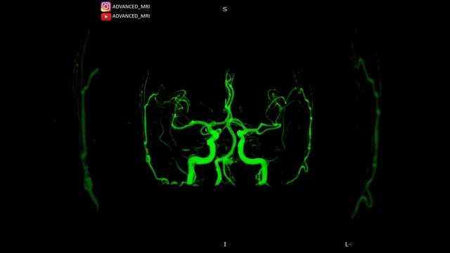 3D TOF MRA смотреть онлайн