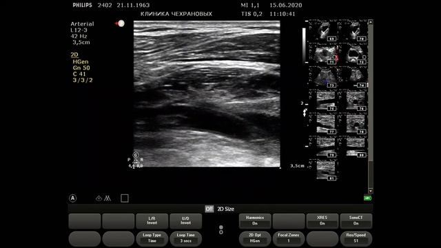 УЗИ артерий нижних конечностей норма 2020 06 15 11 05 55