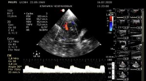 УЗИ сосудов головного мозга , ТКДС , УЗДГ сосудов головного мозга в клинике Чехрановых