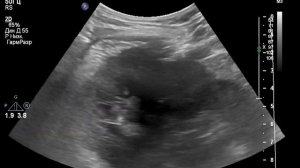 УЗИ мочевой системы. Как найти мочеточник  на уровне перекреста  с подвздошными сосудами?