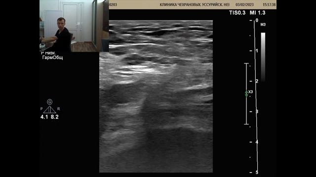 УЗИ сосудов нижних конечностей. Окклюзия бедренных артерий с обеих сторон, но почему слева хуже?