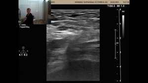 УЗИ сосудов нижних конечностей. Окклюзия бедренных артерий с обеих сторон, но почему слева хуже?