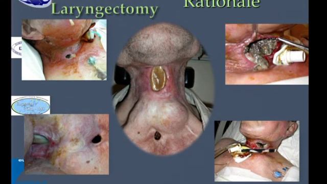Transoral Surgery Video Session: Laser Microsurgery - TLM to Transoral Robotic Surgery (TORS) смотреть онлайн
