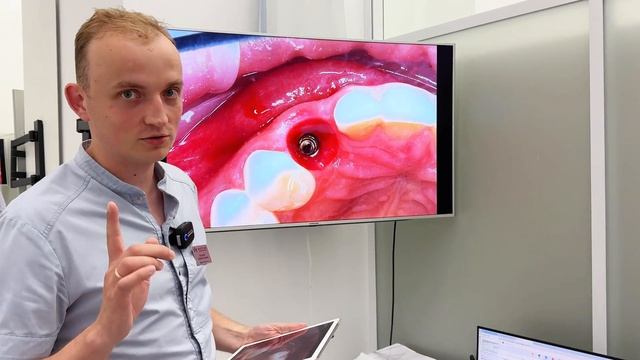 Десневой сосочек. Как нарастить десну. смотреть онлайн