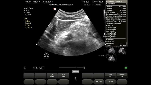 2020061211230694 УЗИ органов брюшной полости
