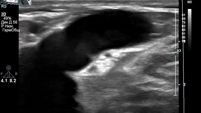 УЗИ вен нижних конечностей при варикозе.