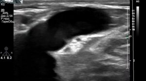 УЗИ вен нижних конечностей при варикозе.