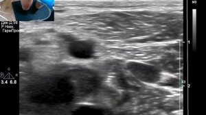 УЗИ вен ног.  Тромбоз  глубоких вен.