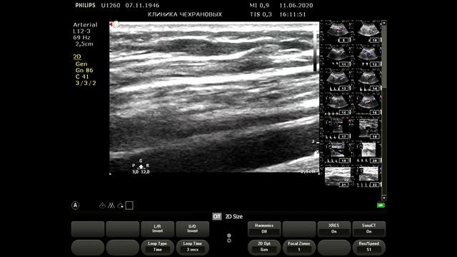 2020061115545771 УЗИ артерий ног