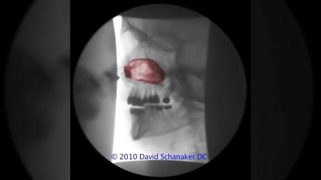 Nasal Cranial Release Fluoro Movie смотреть онлайн