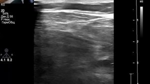 УЗИ артерий нижних конечностей при боли и судорогах, в чем причина? Есть ишемия?