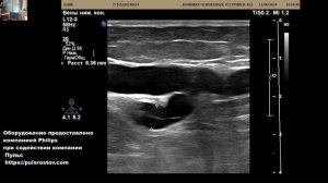 УЗИ вен нижних конечностей Уссурийск. Тромбоз вен + варикоз