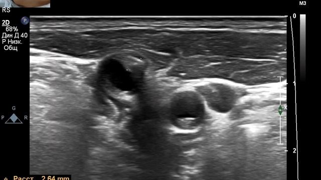 Чехранов Андрей:  Вези в УЗИ