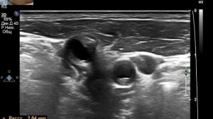 УЗИ БЦА . Как ставить датчик? Что такое ECST & NASCET?