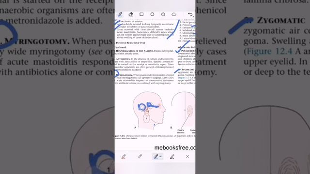 Ear || Chap. 12 || Complications of SOM || imp UQs and MCQs смотреть онлайн