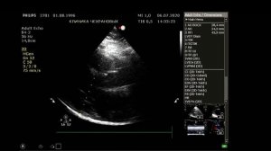 УЗИ сонных артерий ( УЗИ экстракраниальных брахиоцефальных артерий), УЗИ сердца.