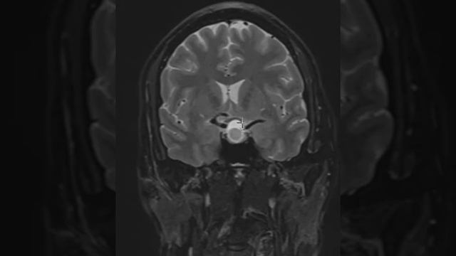 Pituitary Apoplexy смотреть онлайн