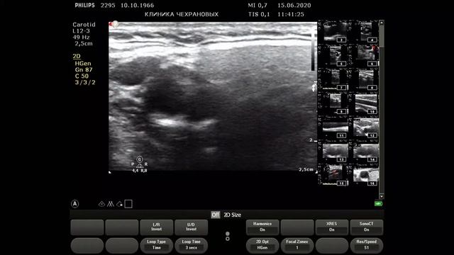 Атеросклероз бца 30% 2295 2020 06 15 11 31 28