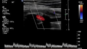УЗИ БЦА . Латентный стил синдром. Как выявить,  если кровоток в позвоночной антеградный?