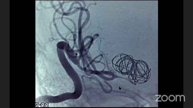 Dr. Roberto Herrera: High flow bypass. Indications and technical details. смотреть онлайн