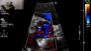 ЭХОКГ ( УЗИ сердца) полный протокол с описанием.