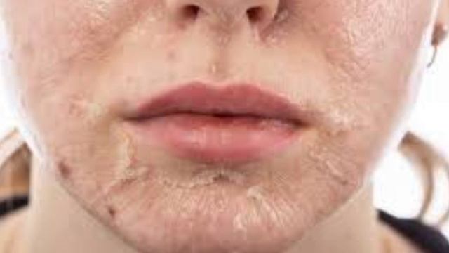 اكبر خطأ كديروه كيدمر البشرة 🤔حروق الوجه السطحية و العميقة مصيرها تصبغات جلدية 😔اليكم الحل 🧐 смотреть онлайн