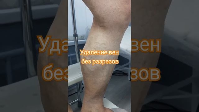 Удаление вен без разрезов. #флебологмосква #операциянавенах #варкиоз смотреть онлайн