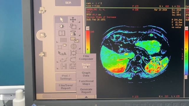 Субтракция серий в МРТ на томографе GE