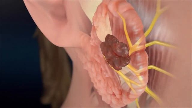 What is pleomorphic adenoma? смотреть онлайн